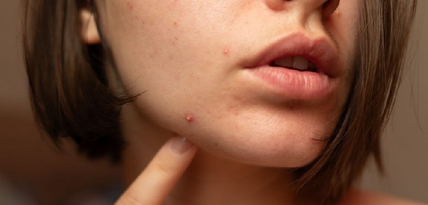 Acne Treatment and Prevention